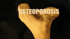Calcium supplements questioning their effectiveness against osteoporosis.