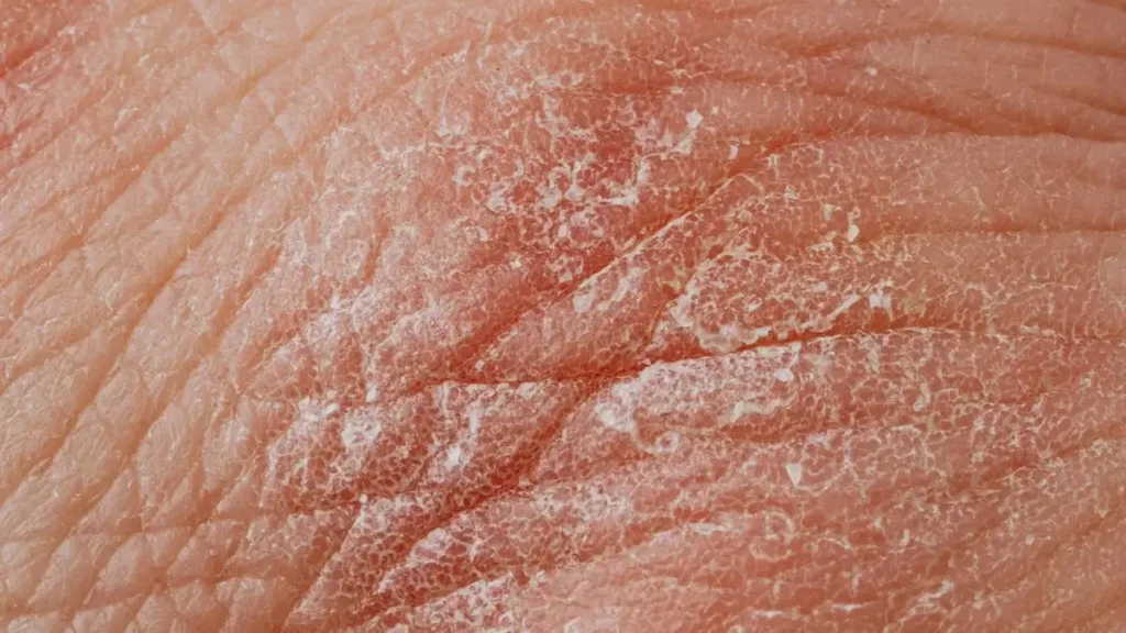 Medicine bottle, pills and a stethoscope representing diabetes and recurrent skin infections.