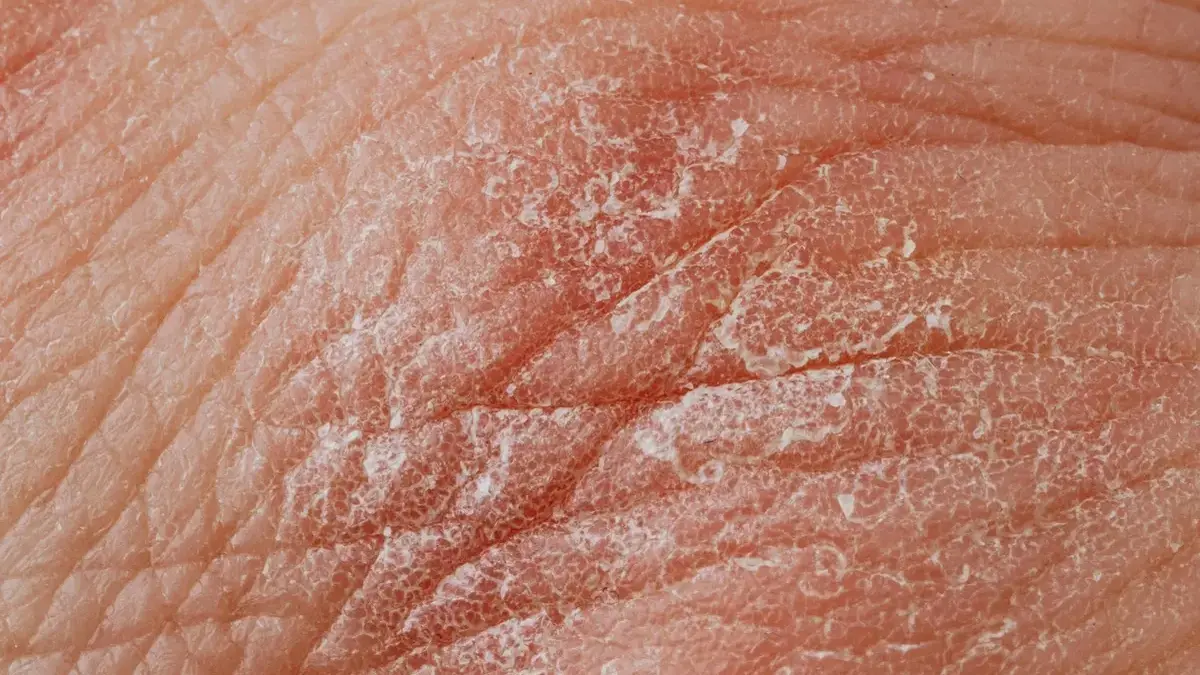 Medicine bottle, pills and a stethoscope representing diabetes and recurrent skin infections.