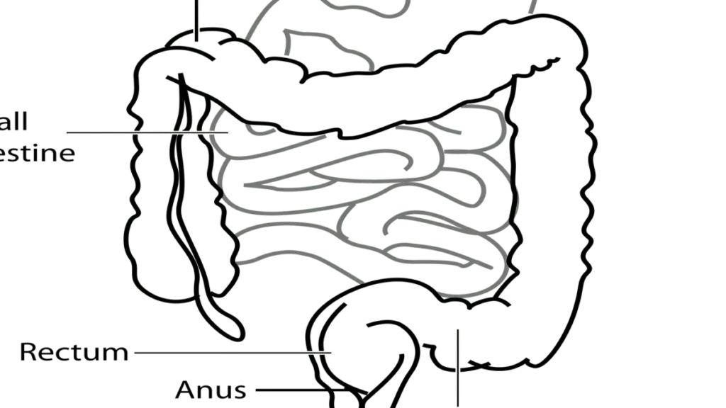 Illustration of colon cancer development linked to gut bacteria and microbiome changes in young adults.