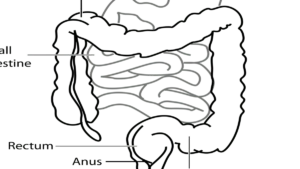 Illustration of colon cancer development linked to gut bacteria and microbiome changes in young adults.
