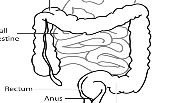 Illustration of colon cancer development linked to gut bacteria and microbiome changes in young adults.
