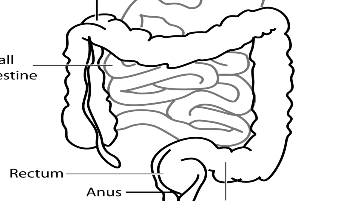 Illustration of colon cancer development linked to gut bacteria and microbiome changes in young adults.