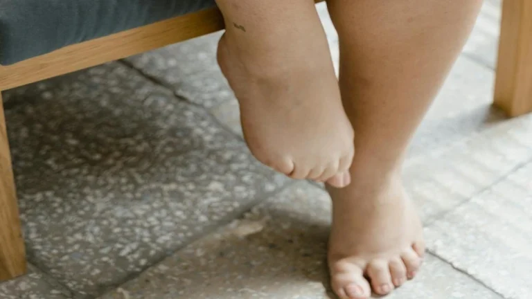Swollen feet and ankles linked to high blood sugar and prediabetes