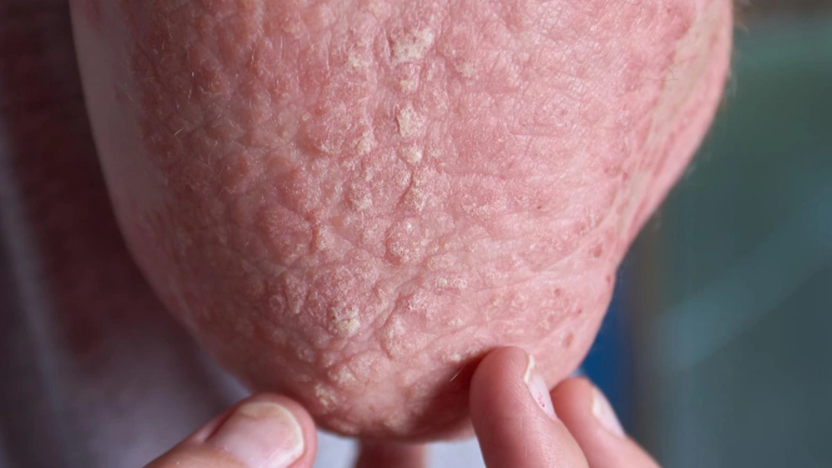 Dupixent (dupilumab) injection treatment for moderate to severe eczema and atopic dermatitis