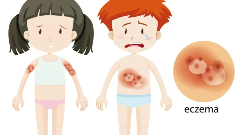 Dermatologist comparing oral JAK inhibitors and injectable biologics for eczema and psoriasis treatment, including Rinvoq, Cibinqo, Dupixent, Cosentyx, and Skyrizi.