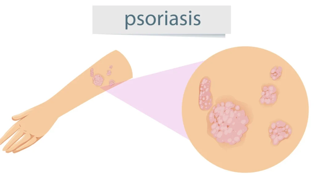 Illustration showing psoriasis symptoms and stages, including mild, moderate, and severe plaque psoriasis with red, inflamed skin covered by silvery-white scales on common areas such as the elbows, knees, scalp, and hands.