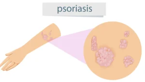 Illustration showing psoriasis symptoms and stages, including mild, moderate, and severe plaque psoriasis with red, inflamed skin covered by silvery-white scales on common areas such as the elbows, knees, scalp, and hands.
