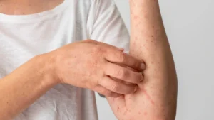 Psoriasis vs eczema comparison showing skin symptoms and modern biologic treatment options for chronic inflammatory skin conditions