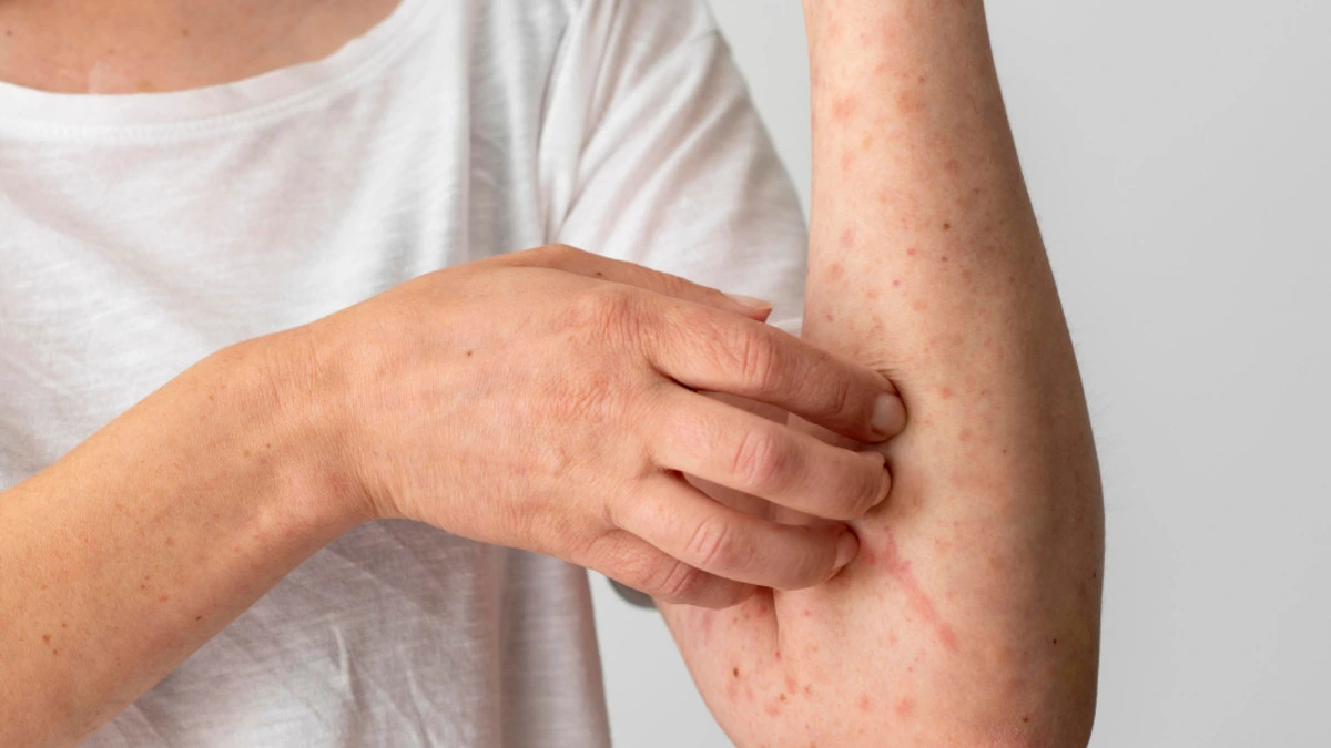 Psoriasis vs eczema comparison showing skin symptoms and modern biologic treatment options for chronic inflammatory skin conditions