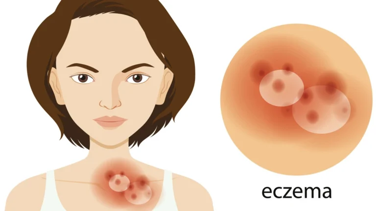 Rinvoq and Cibinqo comparison for eczema treatment, highlighting oral JAK inhibitors used for fast itch relief and skin clearance in atopic dermatitis.