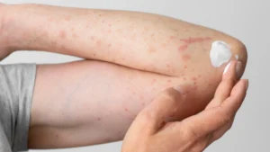 Taltz vs Cosentyx comparison showing two IL-17 inhibitor biologics used for psoriasis treatment