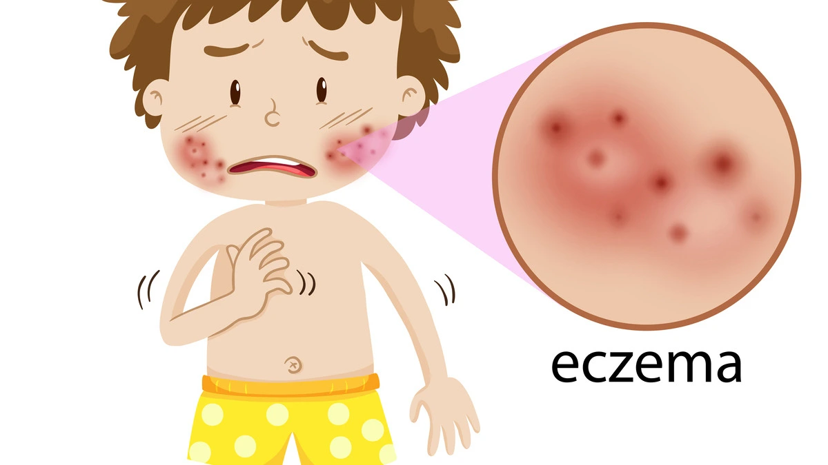 Atopic dermatitis vs contact dermatitis comparison showing eczema symptoms, skin inflammation, redness, itching, and different eczema types