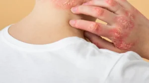 Autoimmune vs allergic disease comparison showing T-cell mediated autoimmune attack versus IgE mast cell allergic response in skin conditions like psoriasis and eczema.