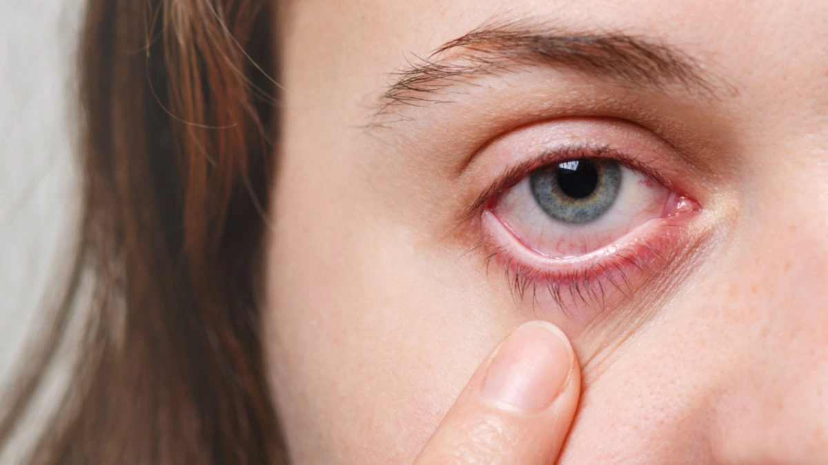 Close-up of a person with dry, irritated eyes showing symptoms of dry eye disease.