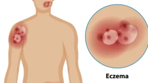Atopic eczema skin inflammation with a concept showing the connection between chronic allergies, vitamin D deficiency, and bone health risk.