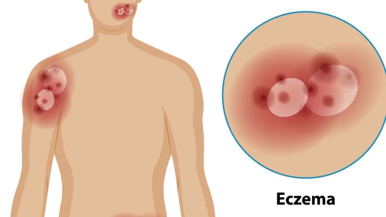Atopic eczema skin inflammation with a concept showing the connection between chronic allergies, vitamin D deficiency, and bone health risk.