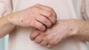 Side-by-side comparison of psoriasis and ringworm showing red, scaly skin patches—psoriasis with thick silvery plaques and ringworm with circular ring-shaped lesions.
