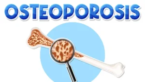 Steroid induced osteoporosis showing reduced bone density in human skeleton
