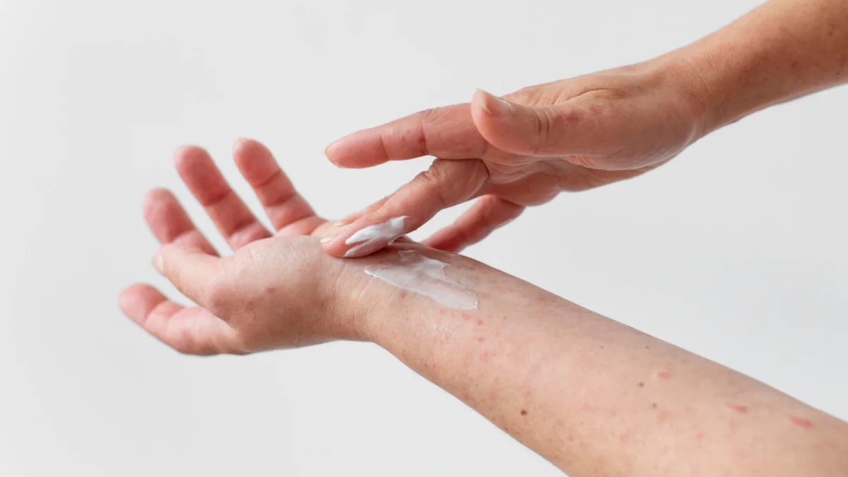 Infographic showing common eczema triggers including soaps, dust mites, stress, food, sweat, and weather
