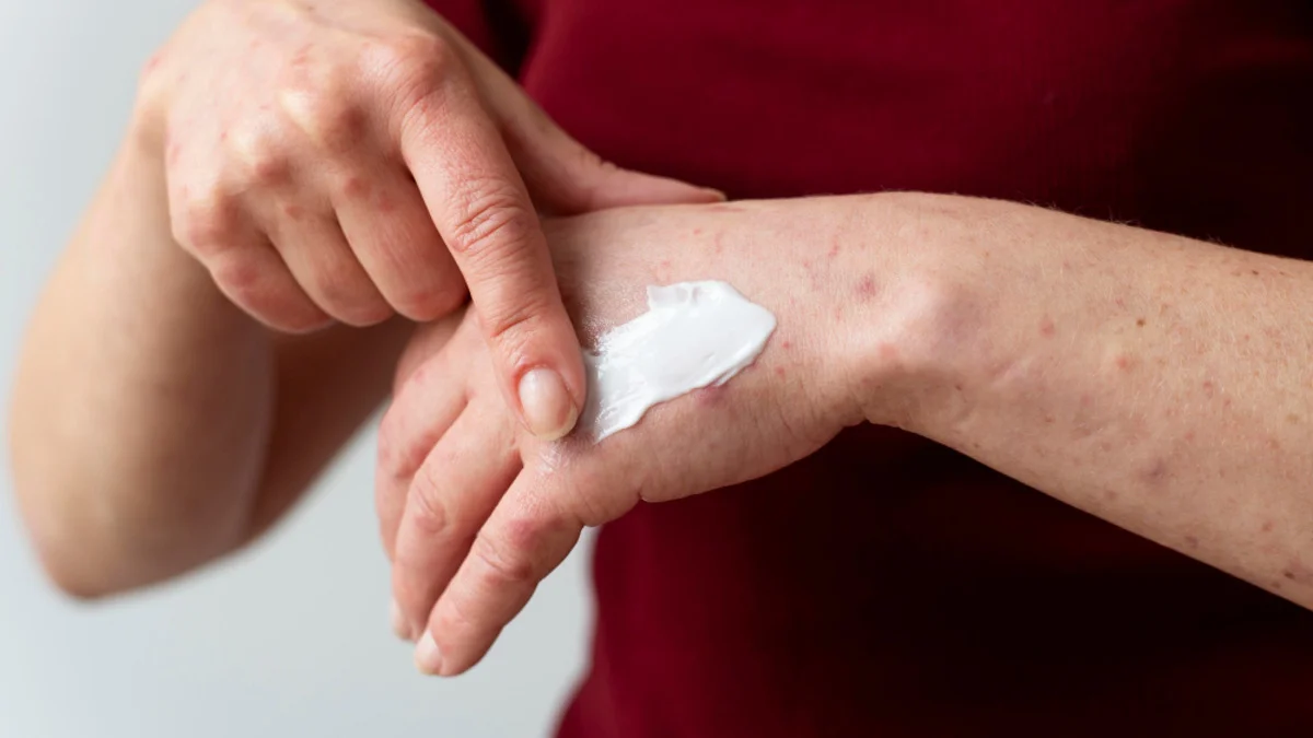 Close-up of eczema-affected skin showing red, dry, inflamed patches during a flare